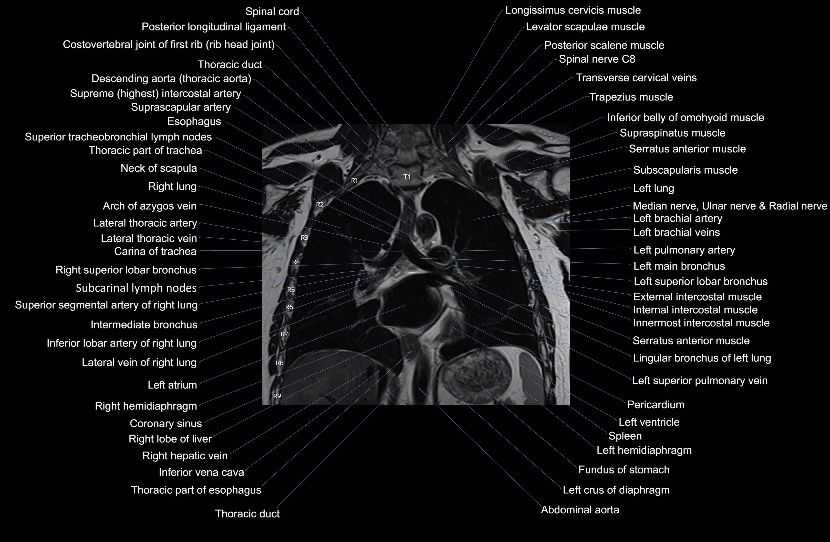MRI chest (thorax) coronal  cross sectional anatomy 3T radiology  image-img-00001-00024.webp